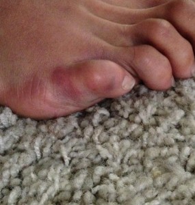 Mike Kyle broken toe